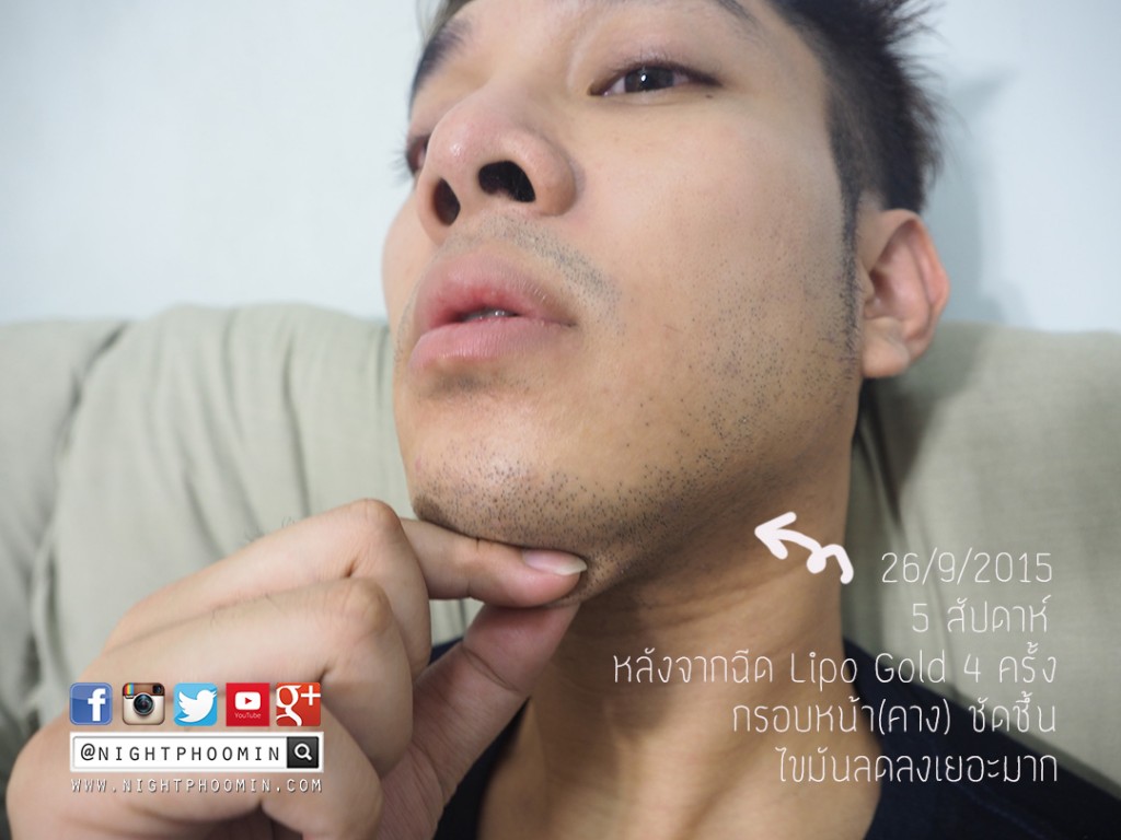 minerva clinic, lipo gold, สลายไขมัน, meso fat, Men's grooming, health, ผิวสวย, สุขภาพดี, บิวตี้บล็อกเกอร์, beauty blogger, รีวิว, พันทิป, pantip