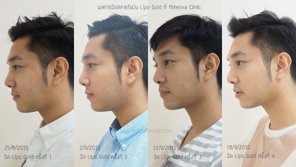 minerva clinic, lipo gold, สลายไขมัน, meso fat, Men's grooming, health, ผิวสวย, สุขภาพดี, บิวตี้บล็อกเกอร์, beauty blogger, รีวิว, พันทิป, pantip