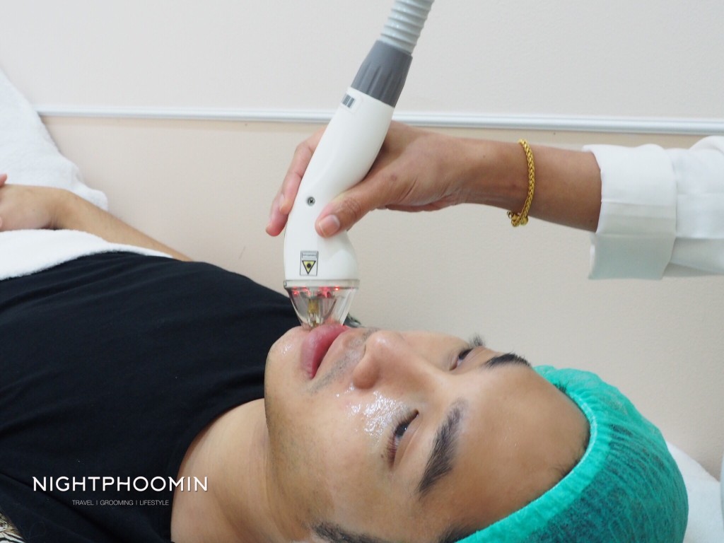 Ulthera, Thermage, minerva clinic, Men's grooming, health, ผิวสวย, สุขภาพดี, บิวตี้บล็อกเกอร์, beauty blogger, รีวิว, review, pantip, พันทิป, เลเซอร์, laser