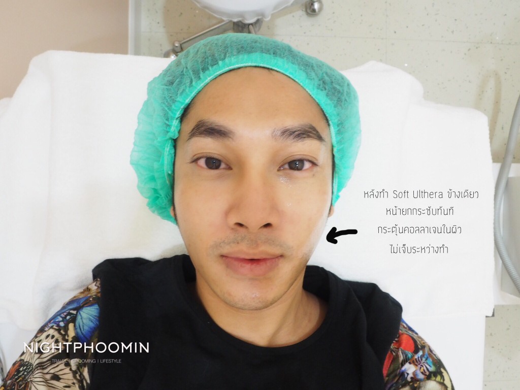 Ulthera, Thermage, minerva clinic, Men's grooming, health, ผิวสวย, สุขภาพดี, บิวตี้บล็อกเกอร์, beauty blogger, รีวิว, review, pantip, พันทิป, เลเซอร์, laser
